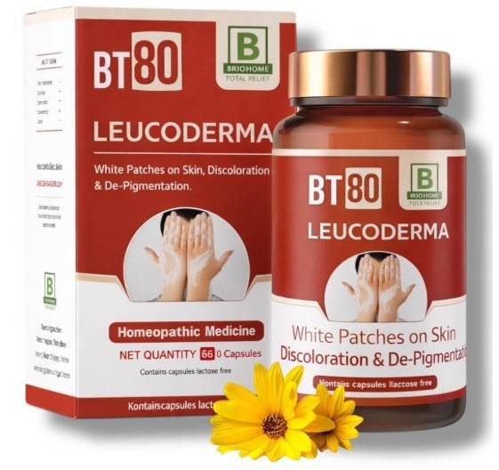 Burnett BT 80 – Homeopathic Remedy for Leucoderma & Vitiligo